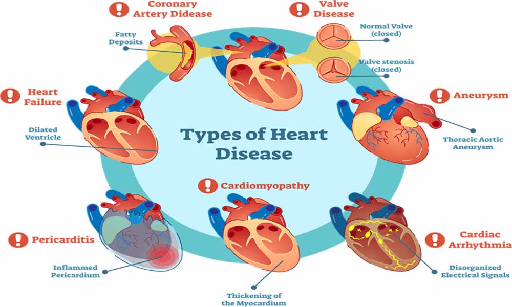 Cardiovascular-Disease