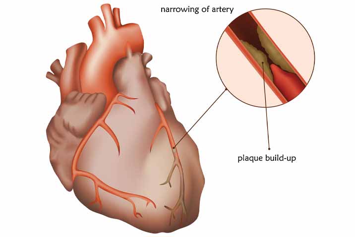 coronary-artery-disease