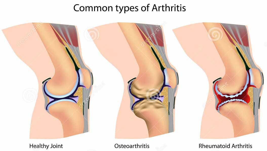 World Arthritis Day Image