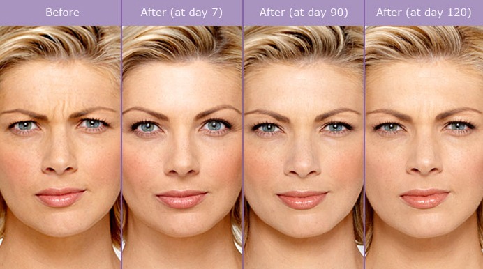 How Long Does Botox Take to Work?